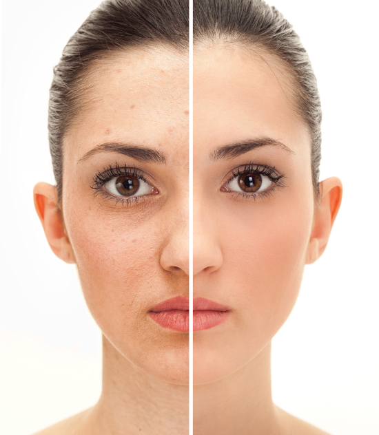 Botox 