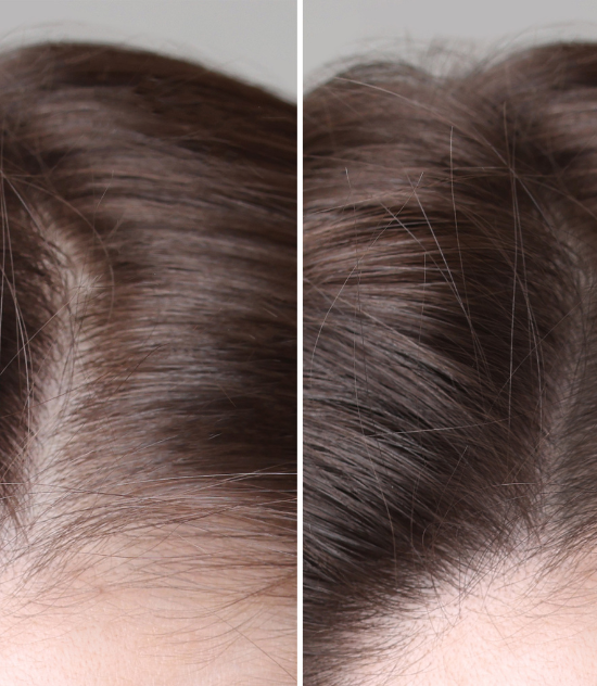 PRP ( Hair / Face ) Treatment – 6 Sessions