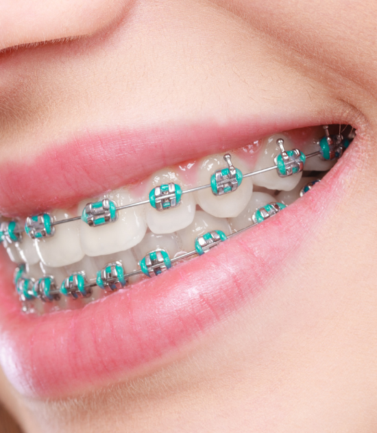 Braces Adjustment 